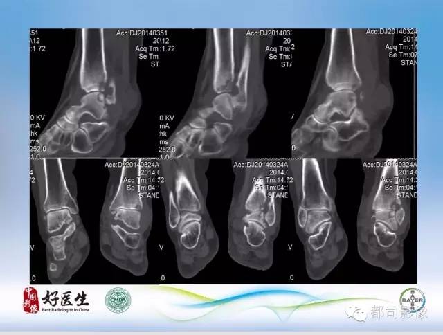 【PPT】骨关节影像病例分析