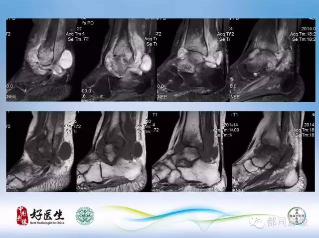 【PPT】骨关节影像病例分析