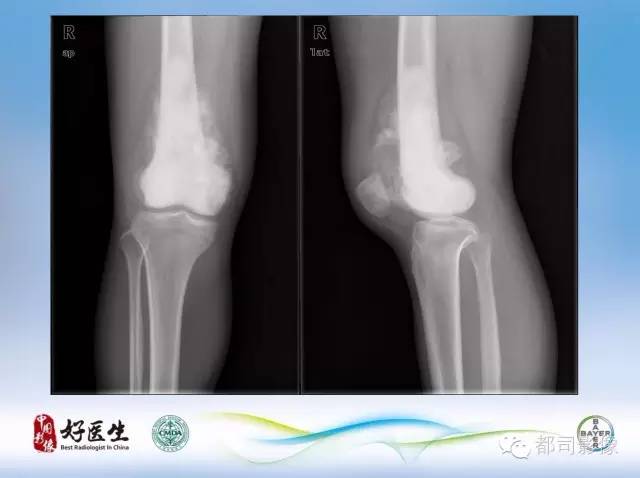 【PPT】骨关节影像病例分析