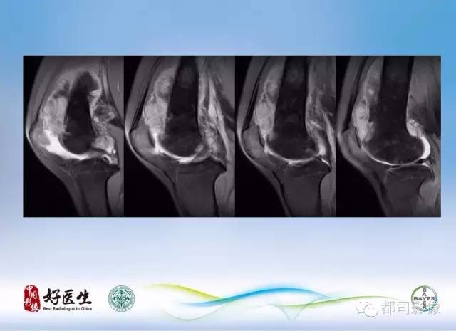 【PPT】骨关节影像病例分析