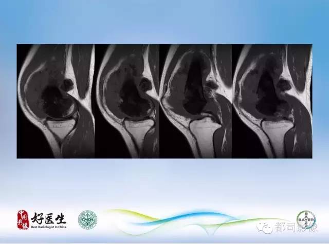 【PPT】骨关节影像病例分析