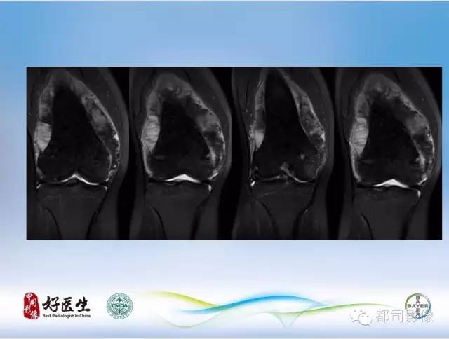【PPT】骨关节影像病例分析