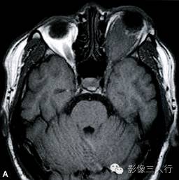 【病例】眼眶脑膜瘤1例MR影像表现分析 【病例】眼眶脑膜瘤1例MR影像表现分析