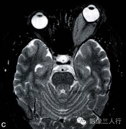 【病例】眼眶脑膜瘤1例MR影像表现分析