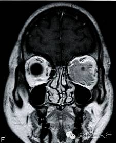 【病例】眼眶脑膜瘤1例MR影像表现分析 【病例】眼眶脑膜瘤1例MR影像表现分析