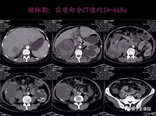 【病例】右肾乳头状肾细胞癌1例CT影像表现 【病例】右肾乳头状肾细胞癌1例CT影像表现