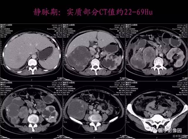【病例】右肾乳头状肾细胞癌1例CT影像表现 【病例】右肾乳头状肾细胞癌1例CT影像表现