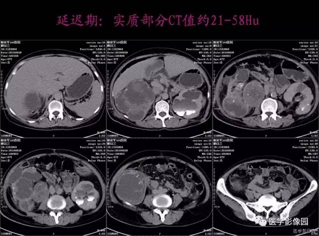 【病例】右肾乳头状肾细胞癌1例CT影像表现 【病例】右肾乳头状肾细胞癌1例CT影像表现