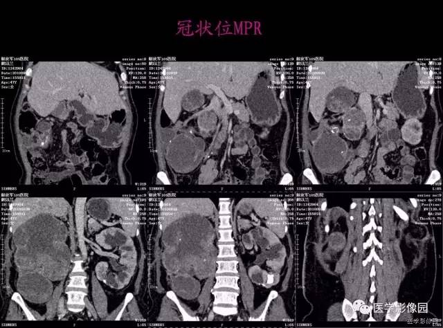 【病例】右肾乳头状肾细胞癌1例CT影像表现 【病例】右肾乳头状肾细胞癌1例CT影像表现