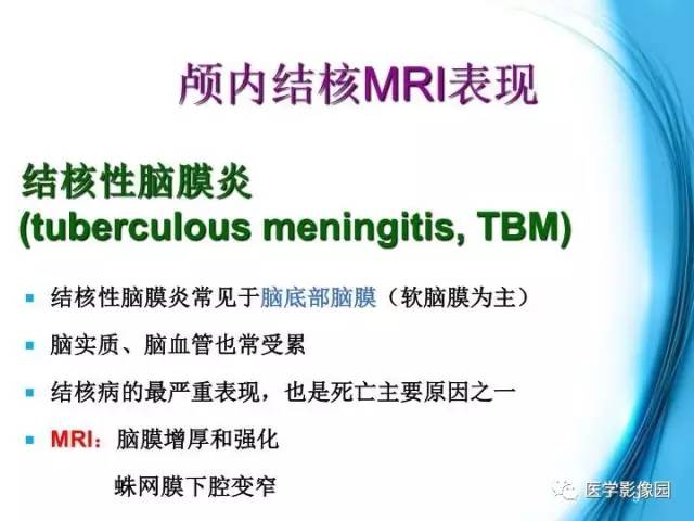 【PPT】颅内结核的磁共振诊断与鉴别