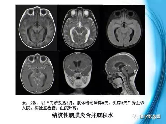 【PPT】颅内结核的磁共振诊断与鉴别