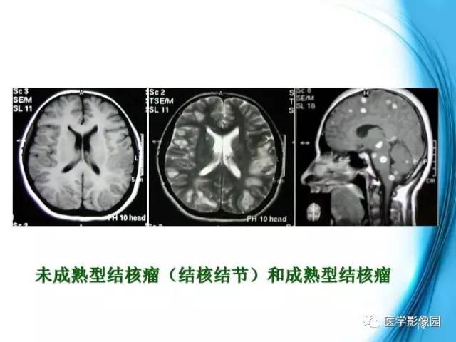 【PPT】颅内结核的磁共振诊断与鉴别