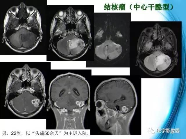 【PPT】颅内结核的磁共振诊断与鉴别