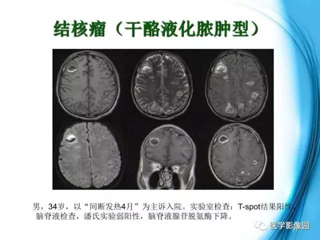 【PPT】颅内结核的磁共振诊断与鉴别