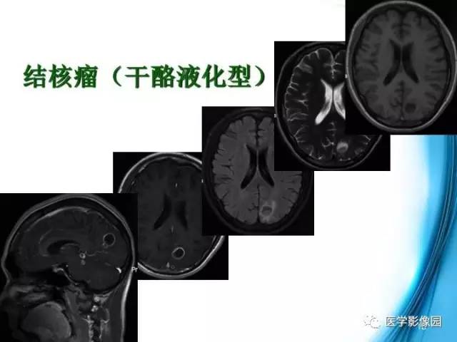 【PPT】颅内结核的磁共振诊断与鉴别