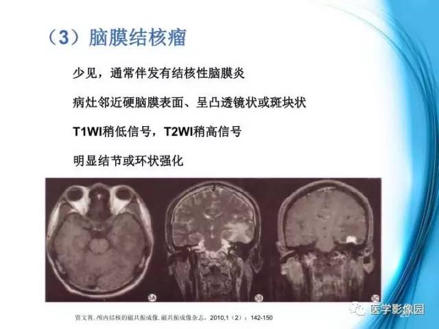 【PPT】颅内结核的磁共振诊断与鉴别