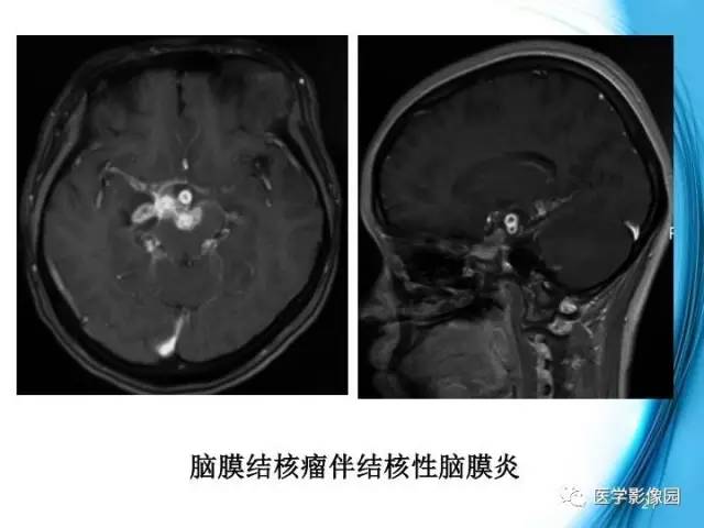 【PPT】颅内结核的磁共振诊断与鉴别