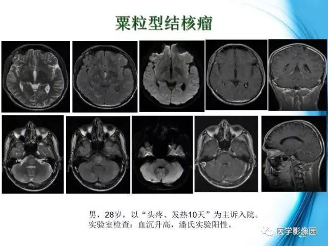 【PPT】颅内结核的磁共振诊断与鉴别