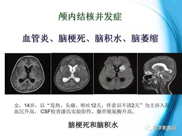【PPT】颅内结核的磁共振诊断与鉴别
