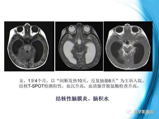 【PPT】颅内结核的磁共振诊断与鉴别