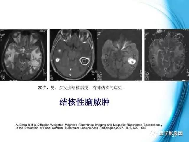 【PPT】颅内结核的磁共振诊断与鉴别