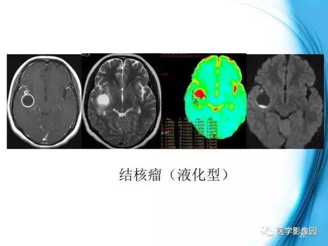 【PPT】颅内结核的磁共振诊断与鉴别