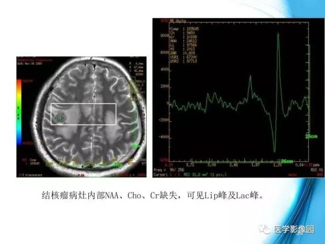 【PPT】颅内结核的磁共振诊断与鉴别