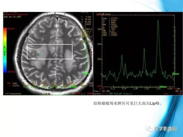 【PPT】颅内结核的磁共振诊断与鉴别