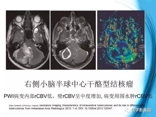 【PPT】颅内结核的磁共振诊断与鉴别