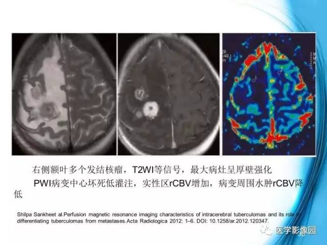 【PPT】颅内结核的磁共振诊断与鉴别