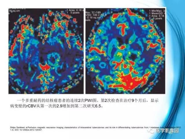 【PPT】颅内结核的磁共振诊断与鉴别