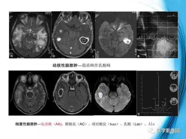 【PPT】颅内结核的磁共振诊断与鉴别