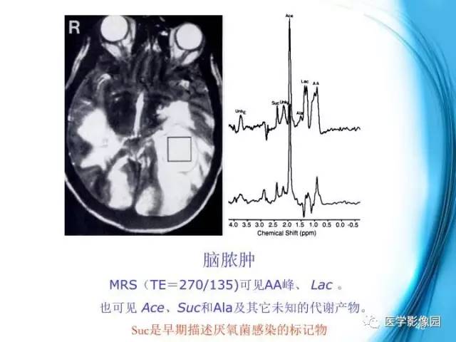 【PPT】颅内结核的磁共振诊断与鉴别