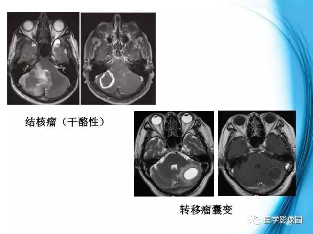 【PPT】颅内结核的磁共振诊断与鉴别