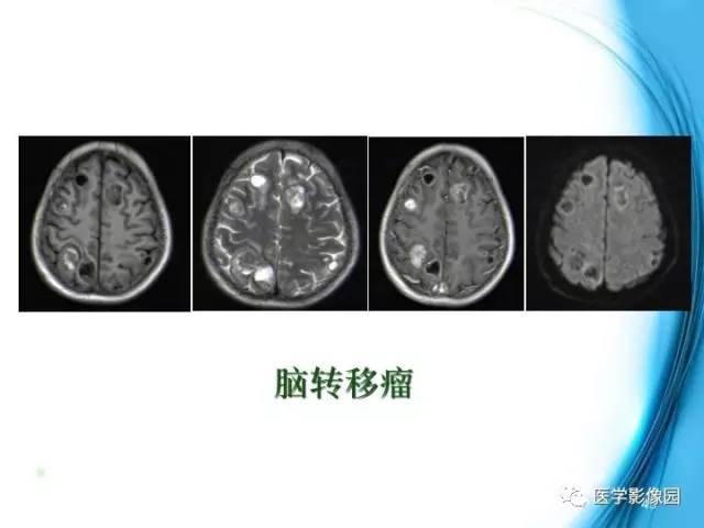 【PPT】颅内结核的磁共振诊断与鉴别