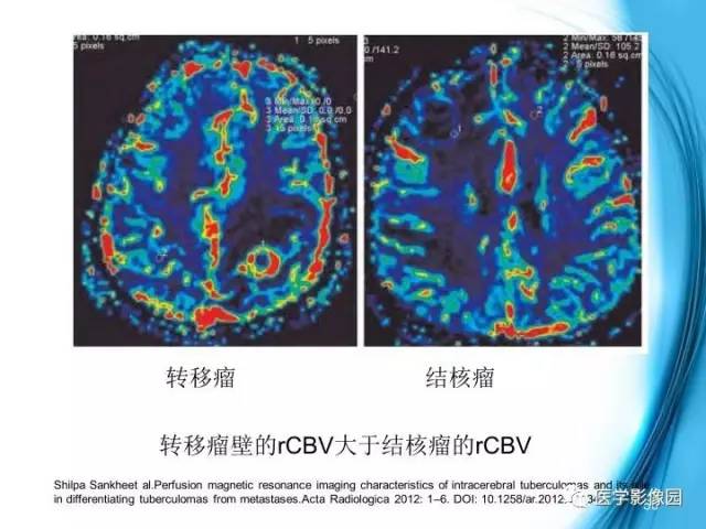 【PPT】颅内结核的磁共振诊断与鉴别
