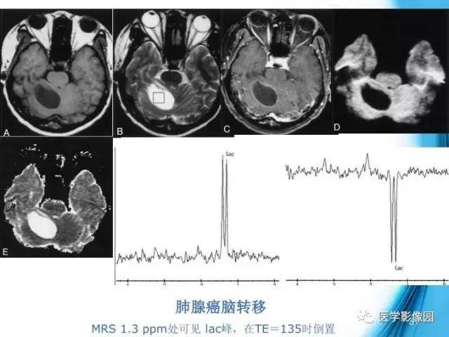 【PPT】颅内结核的磁共振诊断与鉴别