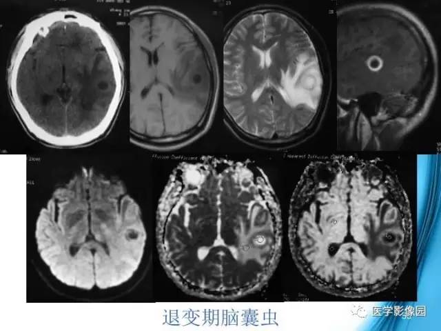 【PPT】颅内结核的磁共振诊断与鉴别
