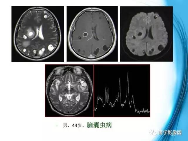 【PPT】颅内结核的磁共振诊断与鉴别