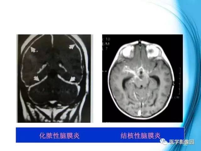 【PPT】颅内结核的磁共振诊断与鉴别