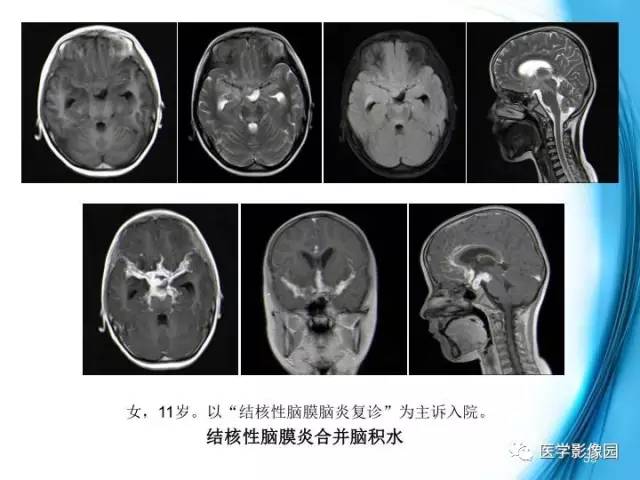 【PPT】颅内结核的磁共振诊断与鉴别