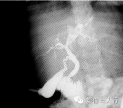 【病例】原发性硬化性胆管炎1例CT及MR影像表现 【病例】原发性硬化性胆管炎1例CT及MR影像表现