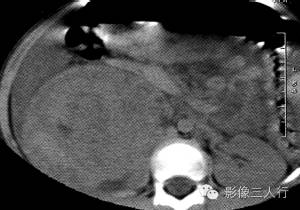 【病例】肾母细胞瘤1例CT影像表现