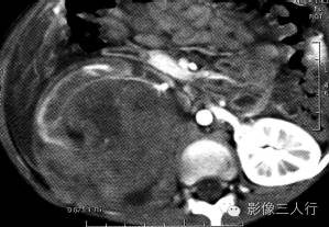 【病例】肾母细胞瘤1例CT影像表现 【病例】肾母细胞瘤1例CT影像表现