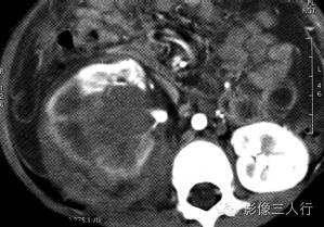 【病例】肾母细胞瘤1例CT影像表现 【病例】肾母细胞瘤1例CT影像表现
