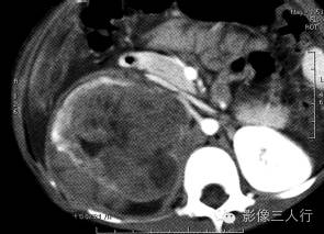 【病例】肾母细胞瘤1例CT影像表现 【病例】肾母细胞瘤1例CT影像表现