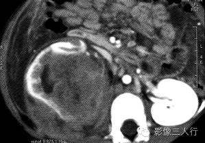 【病例】肾母细胞瘤1例CT影像表现 【病例】肾母细胞瘤1例CT影像表现