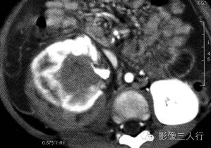 【病例】肾母细胞瘤1例CT影像表现 【病例】肾母细胞瘤1例CT影像表现