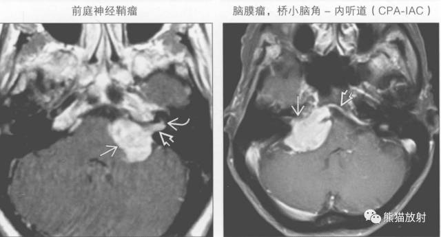“成人桥小脑角肿块”的鉴别诊断