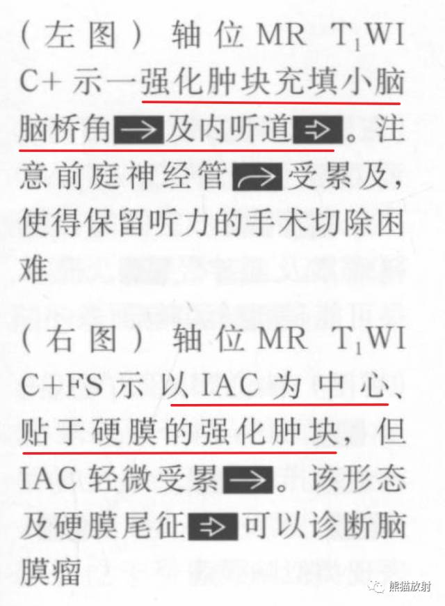 “成人桥小脑角肿块”的鉴别诊断